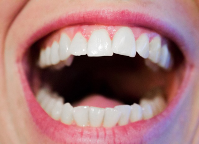 teeth-1652937_400.jpg